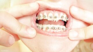This Giantess Eats in Braces